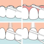 TePe dantų siūlo implantams, tiltams ir breketams naudojimo instrukcija